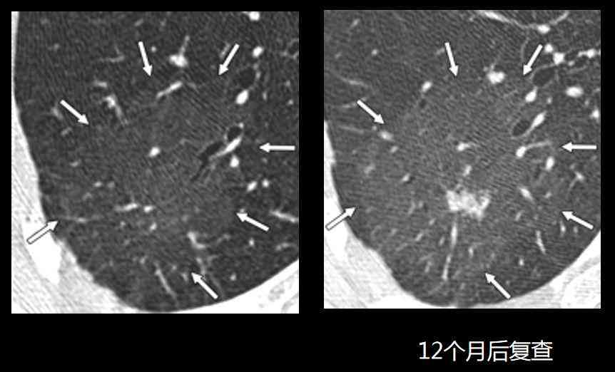 AI智能解读：肺功能检查报告单怎样快速识别怎么看