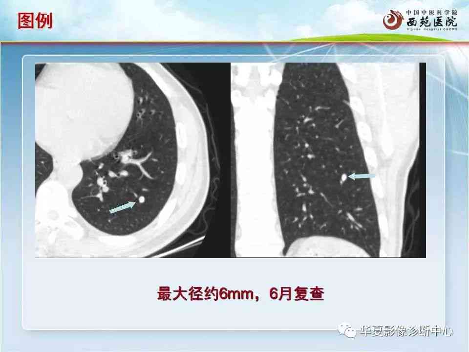 肺功能检测报告解读病例：全面详细解释与临床应用分析