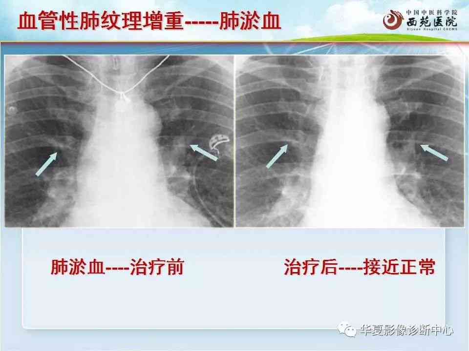 肺功能检测报告解读病例：全面详细解释与临床应用分析