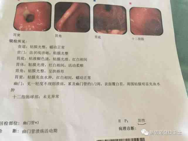 胃镜报告确诊食管癌：解读准确性及后续检查与治疗全攻略