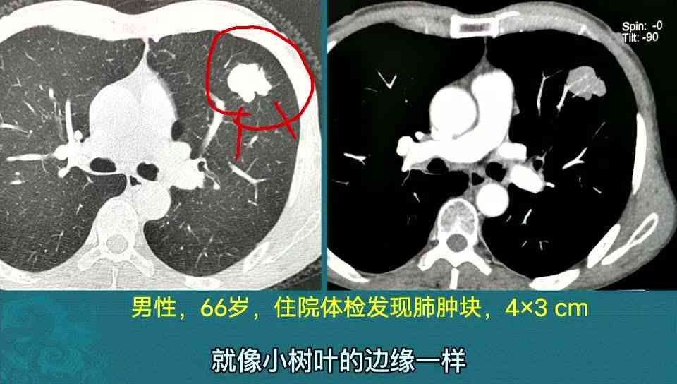 CT报告AIS含义及癌症表述，术后MiA变化，无纯磨或混磨描述解析