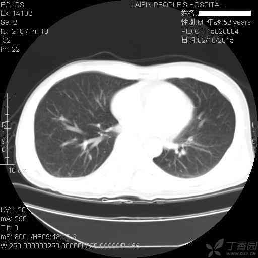 ct报告考虑ais准确吗：肺部CT报告显示考虑准确性几成