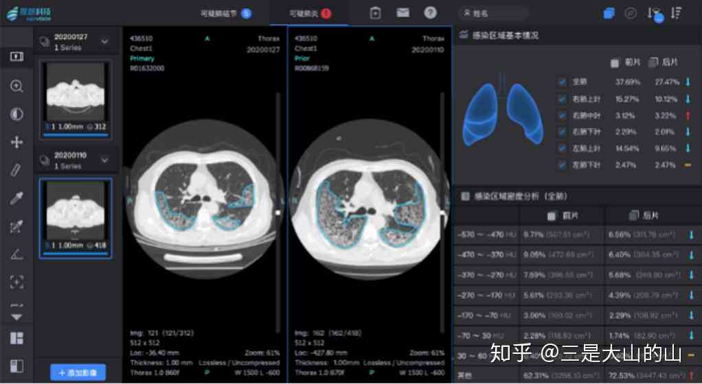 ct报告上ai是