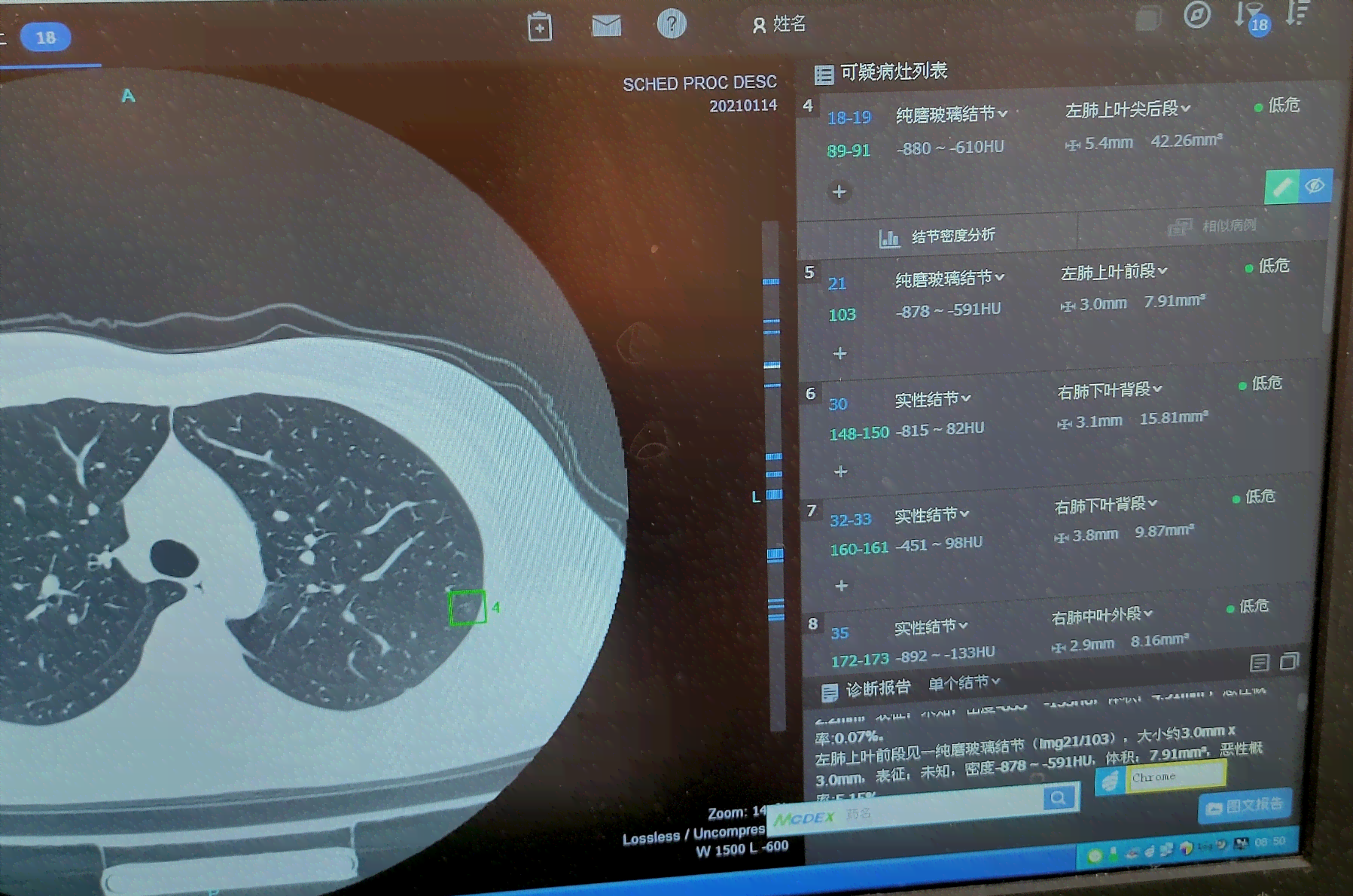 ct报告上ai是