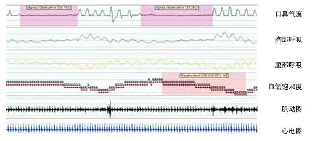 睡眠监测ahi指数-睡眠监测ri指数