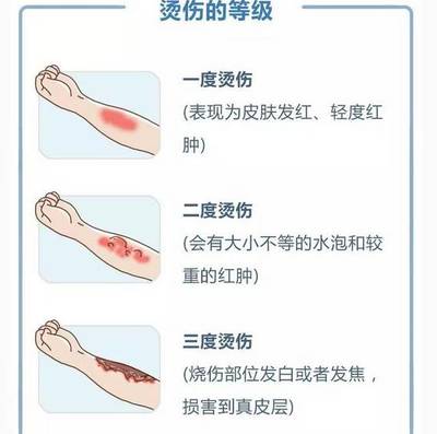 四度烫伤赔偿标准详解：涵医疗、误工、伤残等多方面赔偿细节