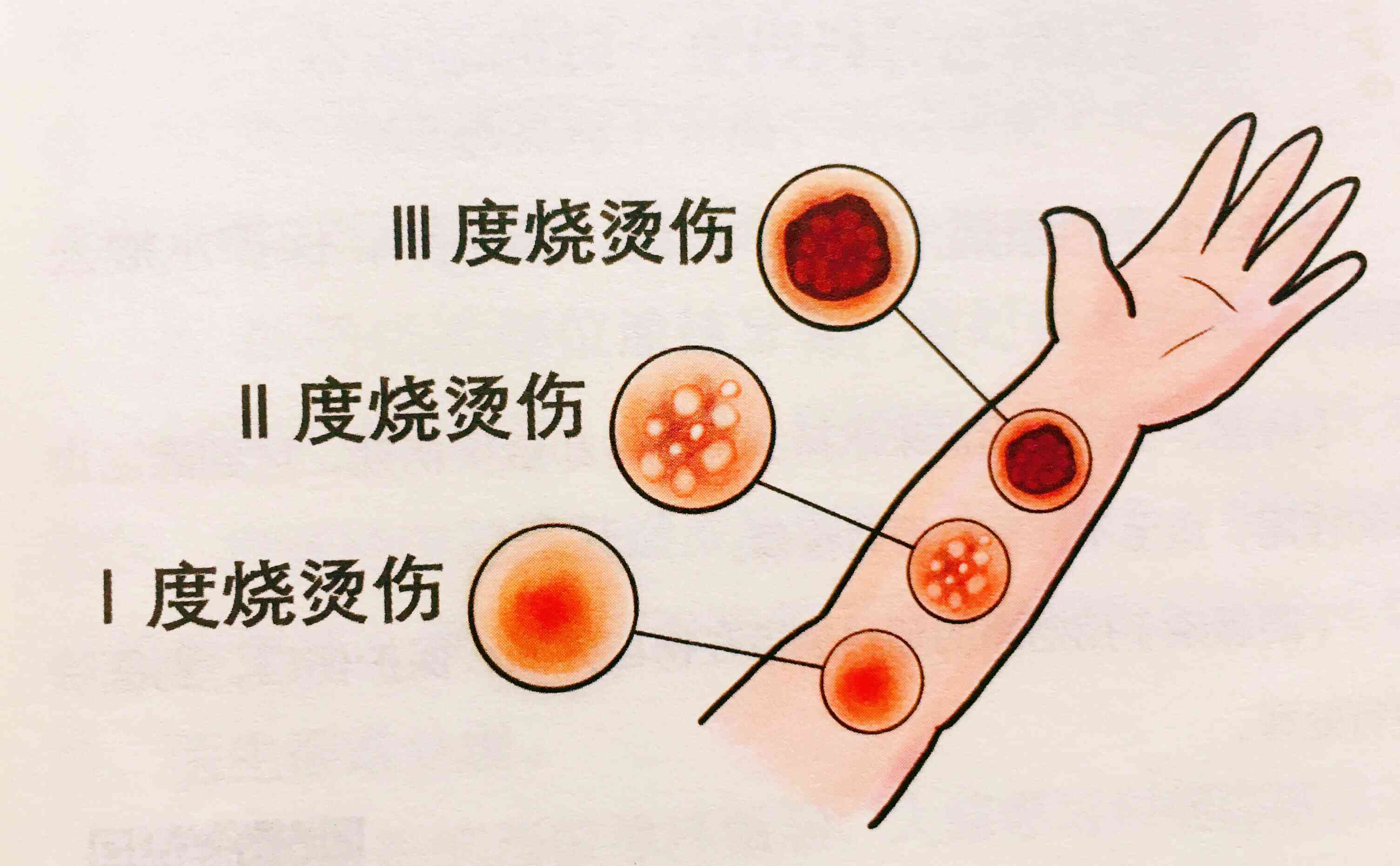 4级烫伤是什么概念及程度解析