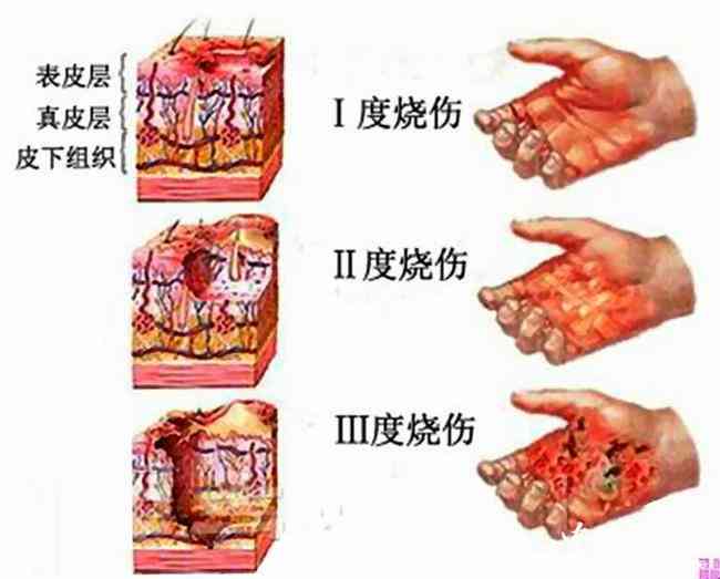 4级烫伤是什么概念及程度解析