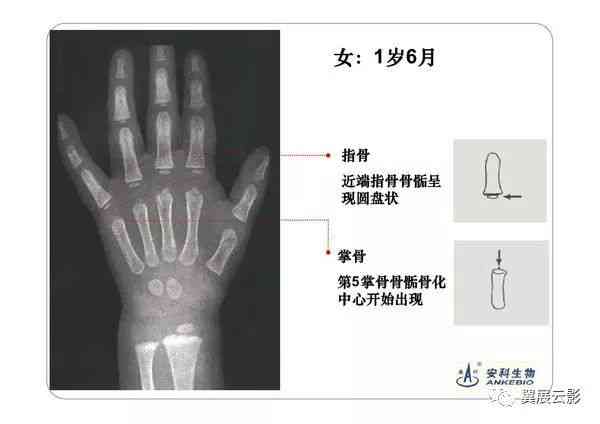 医生教你如何准确解读骨龄健报告单结果