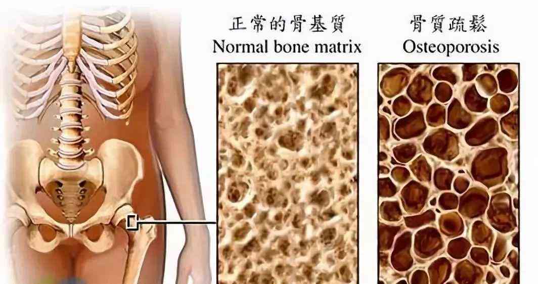 65岁以上工伤赔偿标准：骨折及最新金额一览表