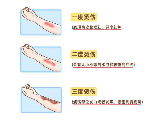 一年多烫伤可以认定工伤吗