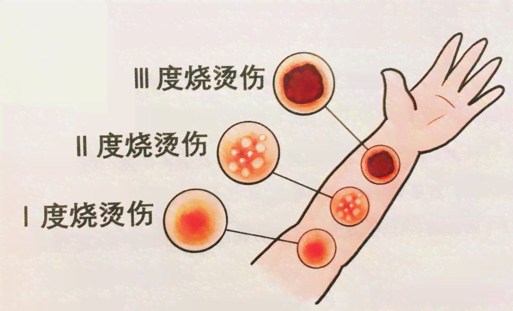 胳膊烧伤急救处理与居家护理指南：如何快速缓解疼痛、预防感染与促进愈合