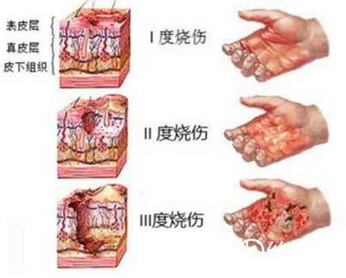 一级烫伤被划分为轻伤等级的标准与界定