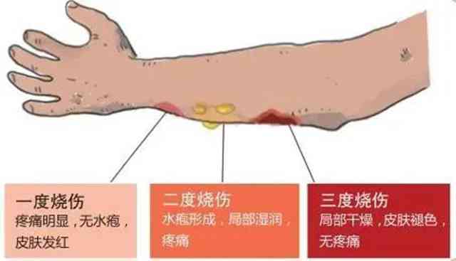 一级烫伤被划分为轻伤等级的标准与界定