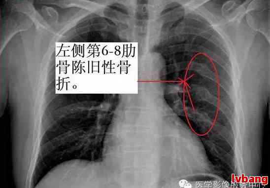 三根肋骨骨折工伤级别判定标准解析