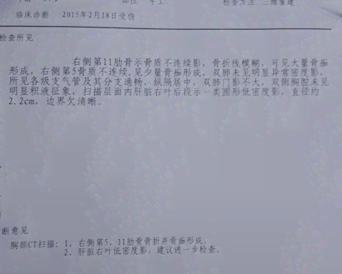 工伤三根肋骨骨折鉴定标准与赔偿细则