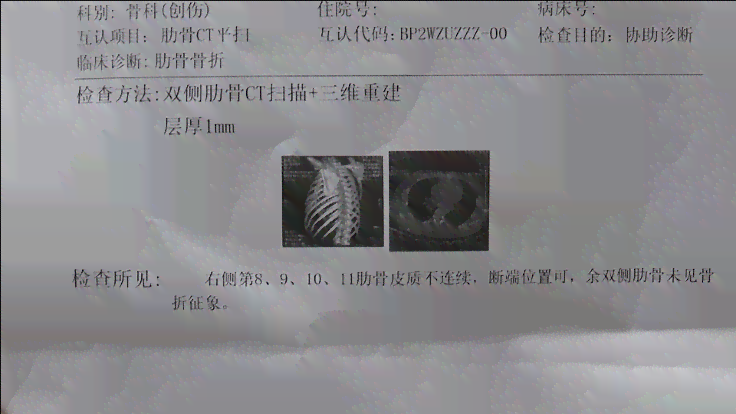 三根肋骨认定工伤标准最新版：骨折级别及赔偿一览表