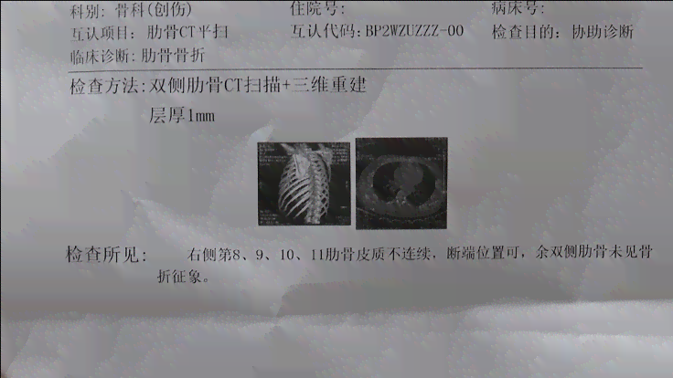 三根肋骨骨折鉴定：工伤等级划分解析