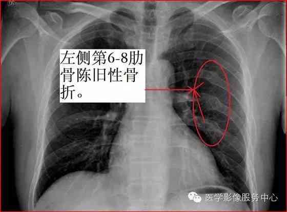 人体损伤程度鉴定：两根肋骨骨折伤残评定标准解析