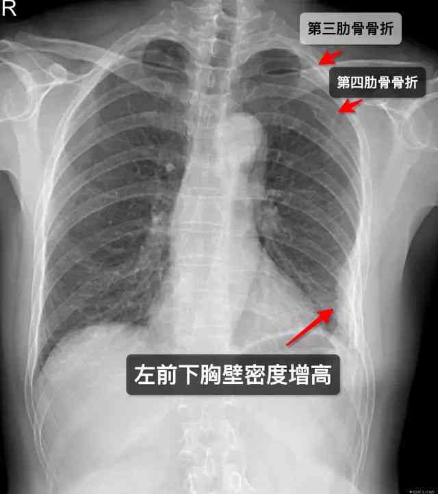 人体损伤程度鉴定：两根肋骨骨折伤残评定标准解析