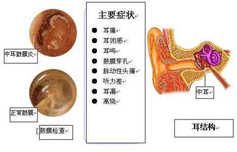 中耳炎可以认定工伤吗