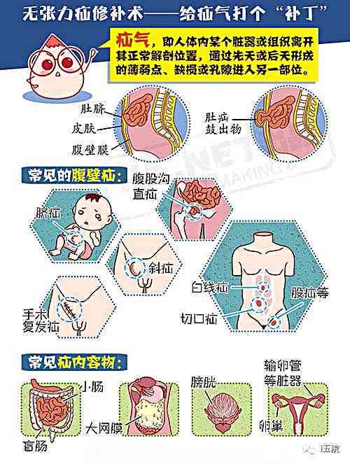 探讨疝气病症在工伤事故认定中的难题与法律依据