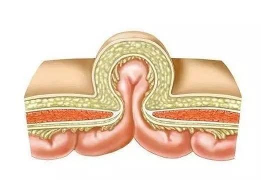 探讨儿与成人疝气高发病率背后的原因及防治策略