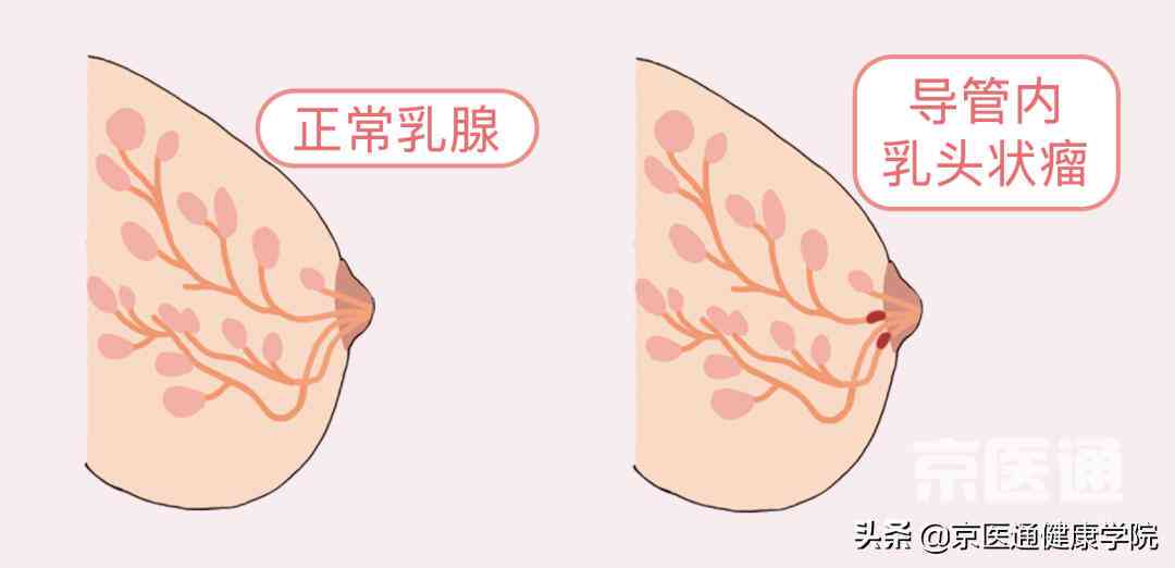 乳腺结节如何影响保险购买与理赔：全面解析投保注意事项与可选产品