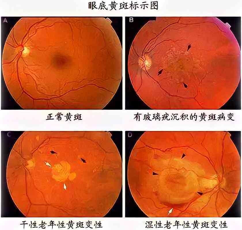 人工智能眼底成像技术综合诊断报告：全面解读眼底健状况与疾病风险