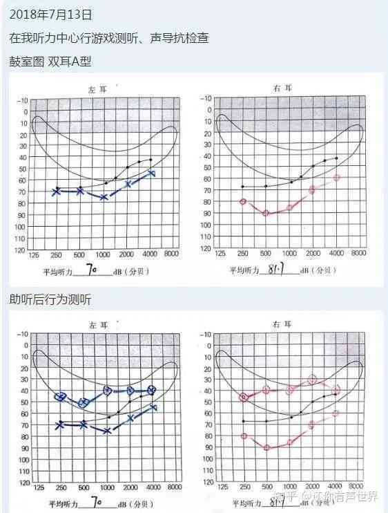 听力测试ai68是什么意思及正常值标准（ai, ac, bc）