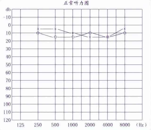 听力测试ai68是什么意思及正常值标准（ai, ac, bc）