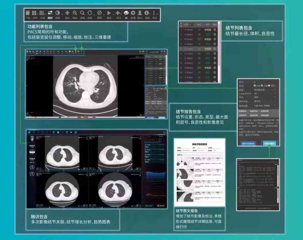 AI智能诊断技术：全面助力肺结节精准识别与良恶性评估