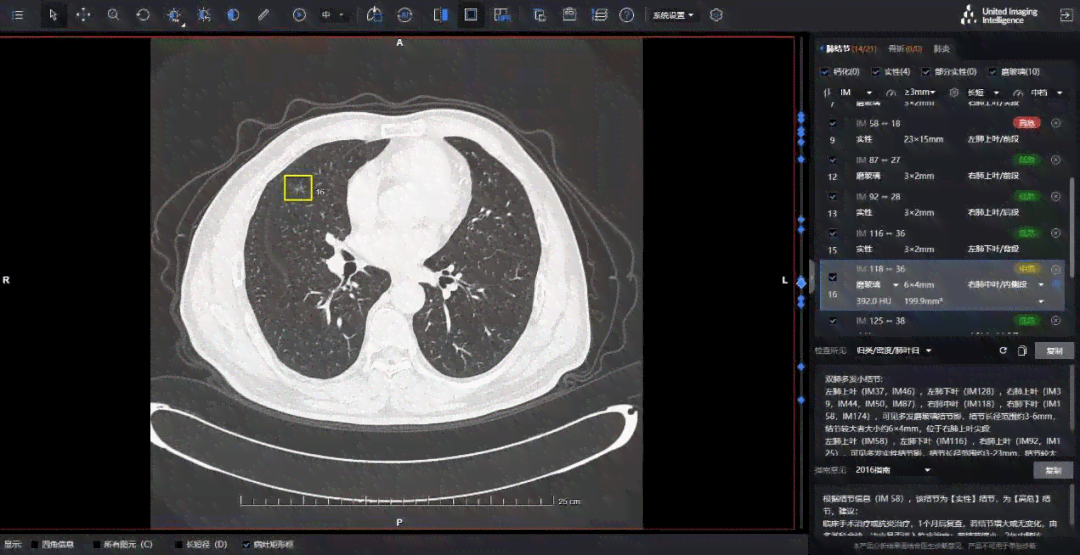 AI智能诊断技术：全面助力肺结节精准识别与良恶性评估