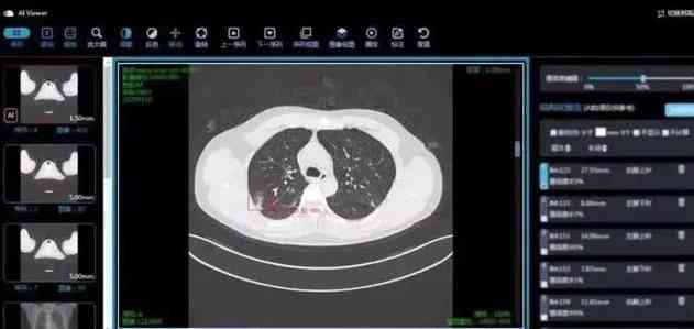 肺小结节人工智能al检查是什么：人工智能诊断与3mm常规筛查准确性高