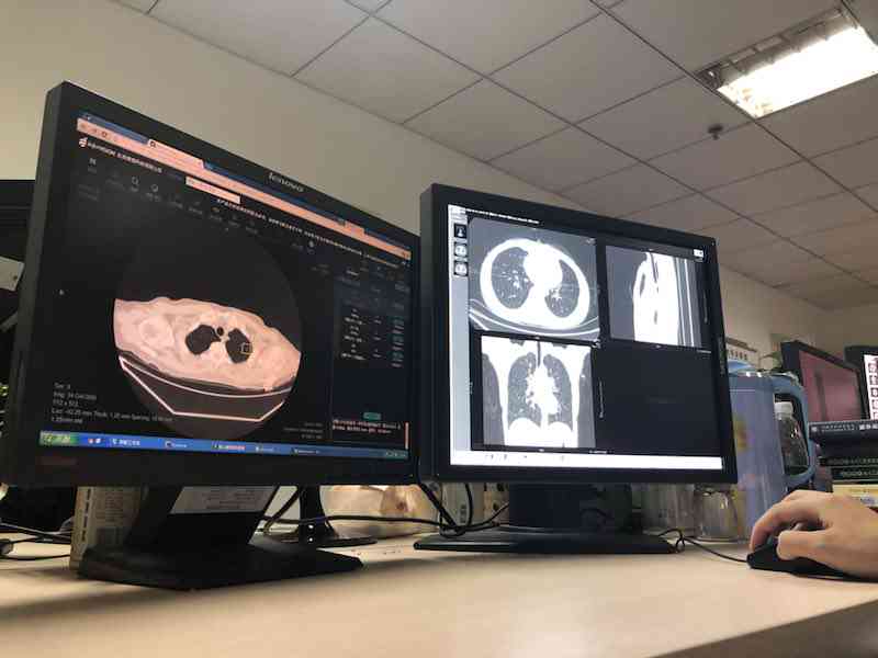 肺小结节人工智能al检查是什么：人工智能诊断与3mm常规筛查准确性高