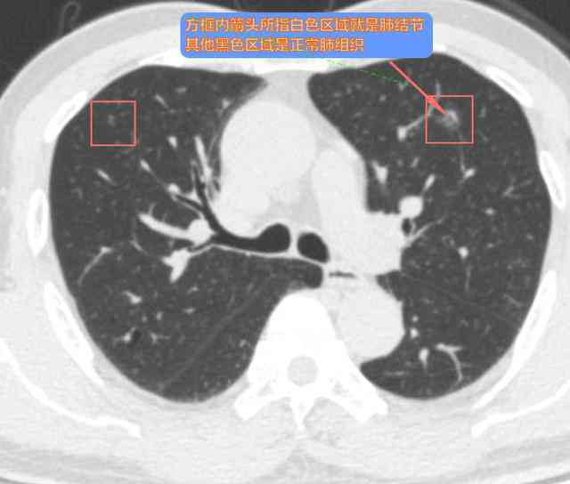 微小肺结节检出率显著提升：健体检中的早期筛查新趋势