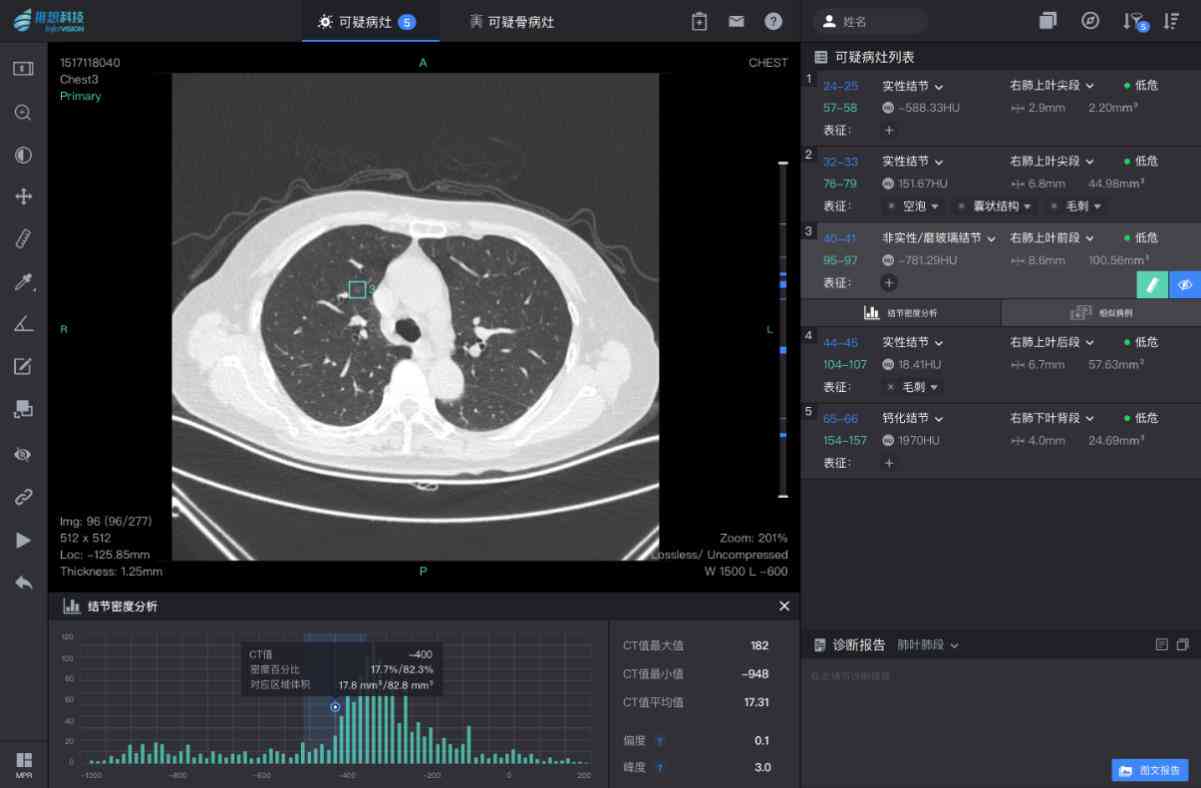 全功能肺结节智能分析软件：精准诊断与跟踪管理一站式解决方案