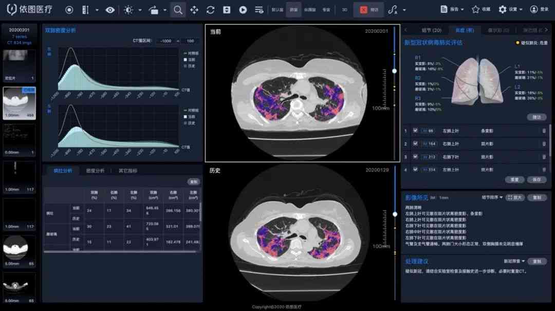 全功能肺结节智能分析软件：精准诊断与跟踪管理一站式解决方案