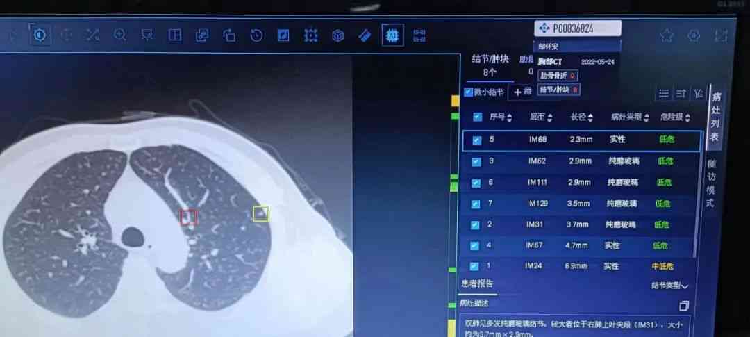 全功能肺结节智能分析软件：精准诊断与跟踪管理一站式解决方案
