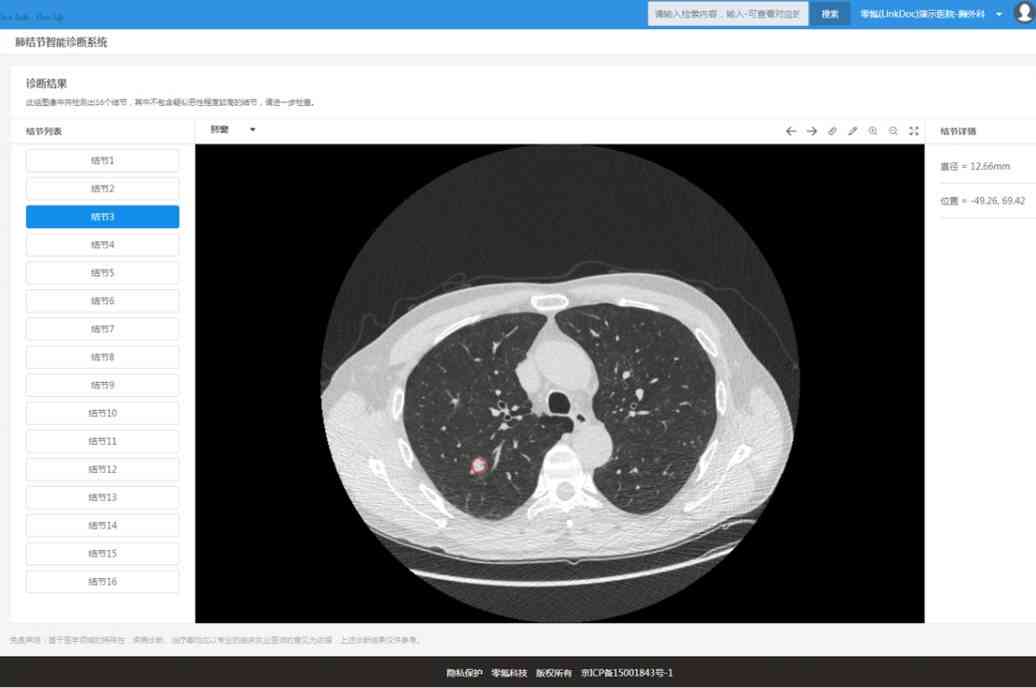 全功能肺结节智能分析软件：精准诊断与跟踪管理一站式解决方案