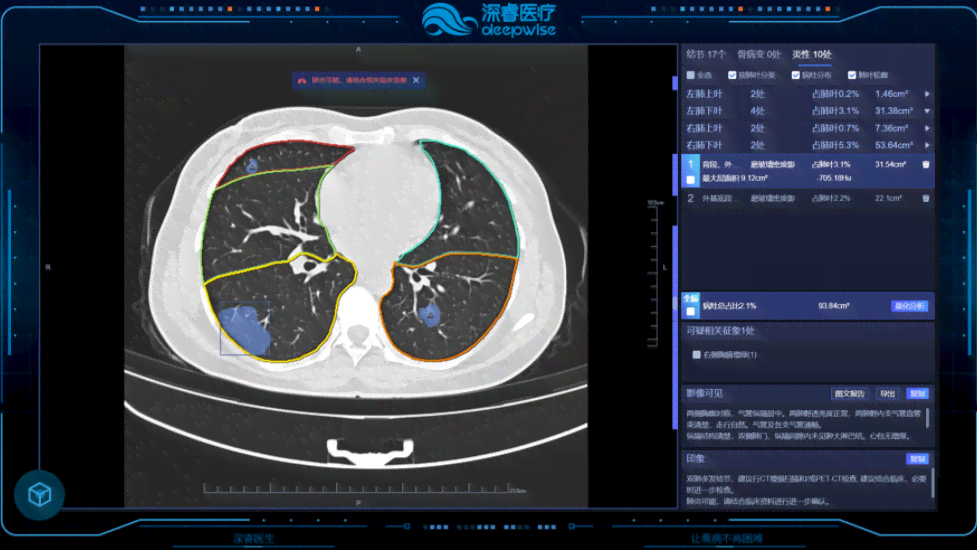 全功能肺结节智能分析软件：精准诊断与跟踪管理一站式解决方案