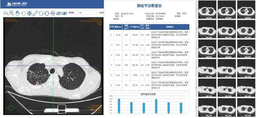 全功能肺结节智能分析软件：精准诊断与跟踪管理一站式解决方案