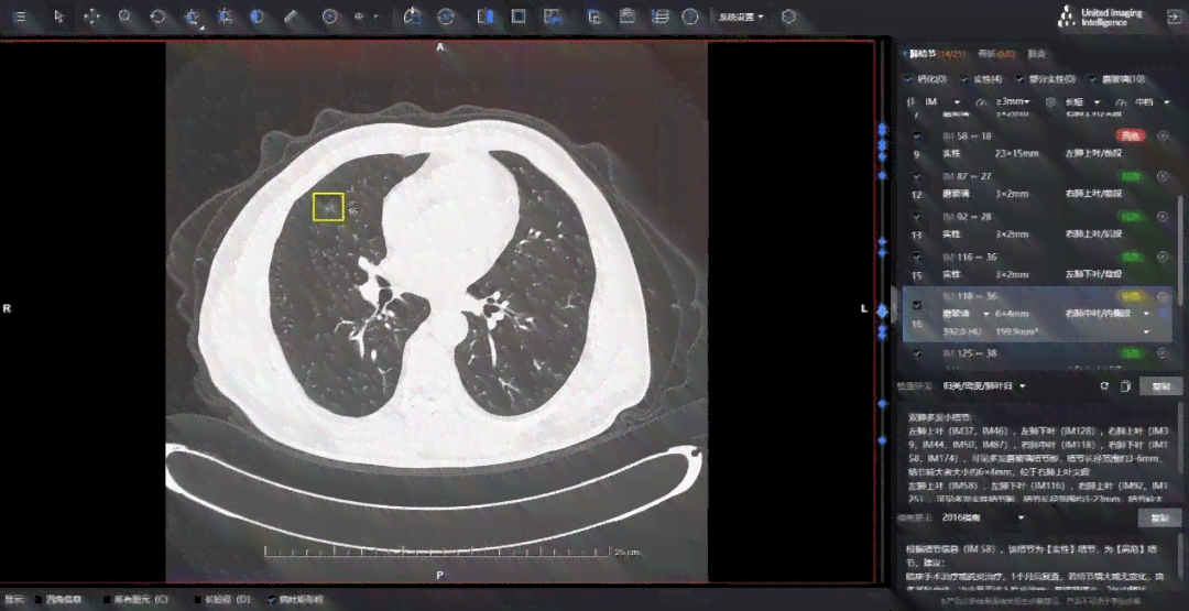 ai智能分析肺微小结节标准报告