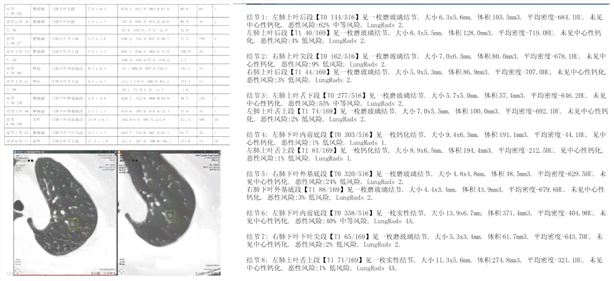 ai智能分析肺微小结节标准报告