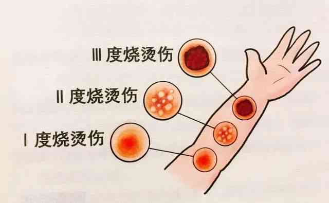 深入了解：如何界定不同程度的烫伤标准与分类