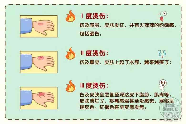 深入了解：如何界定不同程度的烫伤标准与分类