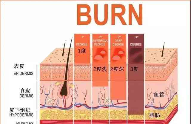 深入了解：如何界定不同程度的烫伤标准与分类