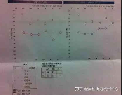 纯音测听报告解读-纯音测听报告解读图片