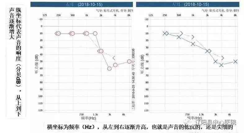 纯音测听ai值正常范围及结果解读：声音数值含义与影响