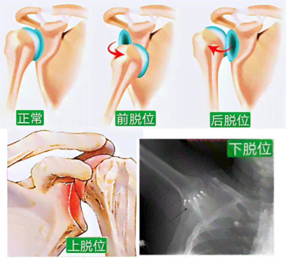 关节脱位算伤残吗：详解关节脱位伤残鉴定标准与法律判定